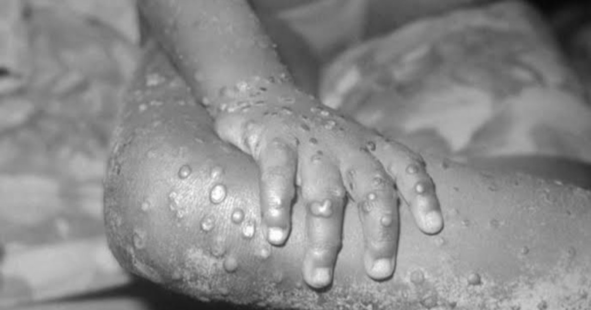 د بیزو تڼاکې یا Monkey pox څه ډول ناروغي ده؟ نښې نښانې یې څه دي