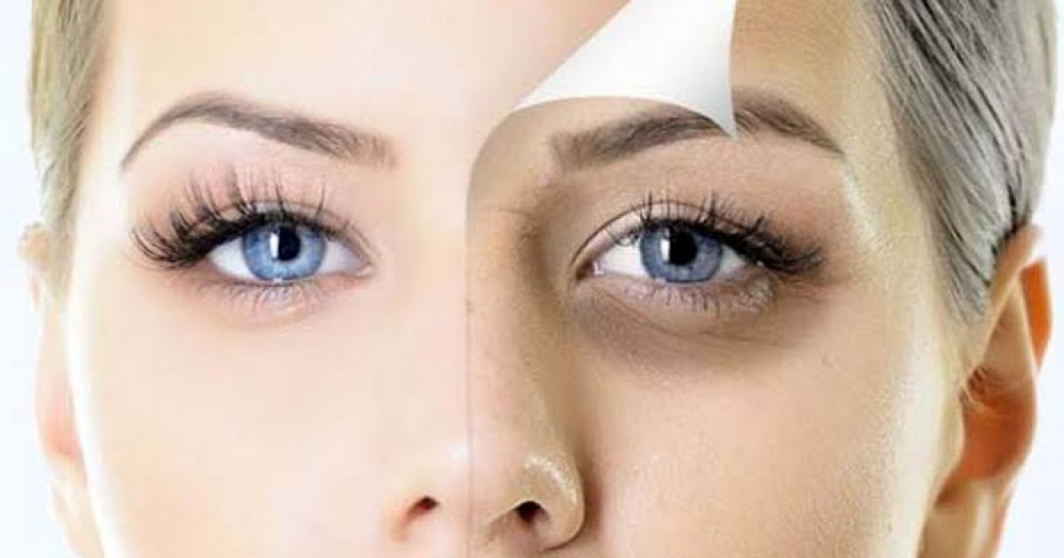 د سترګو شاوخوا تورې حلقې؛ لاملونه او حل لارې یې