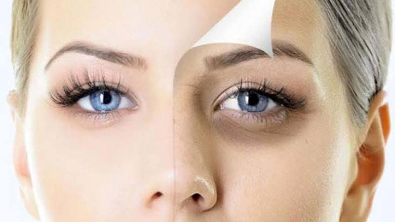 د سترګو شاوخوا تورې حلقې؛ لاملونه او حل لارې یې