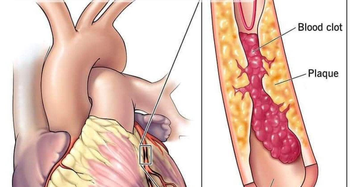 زړه او رګونو ناروغيو عام اعراض