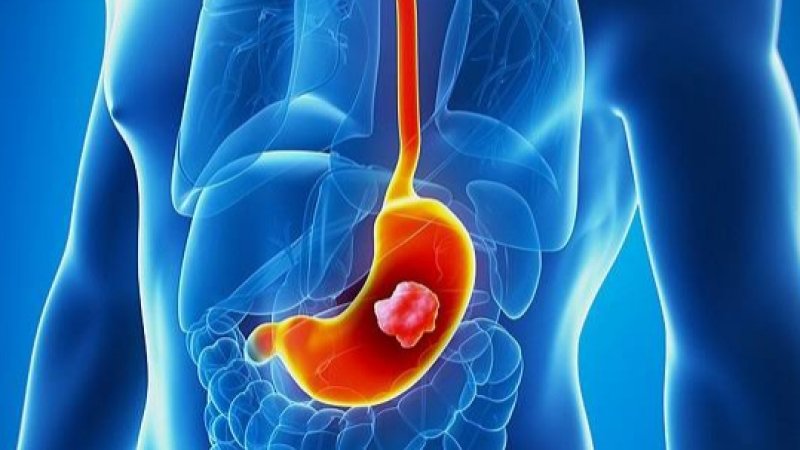 د معدې د سرطان نخښې او لاملونه