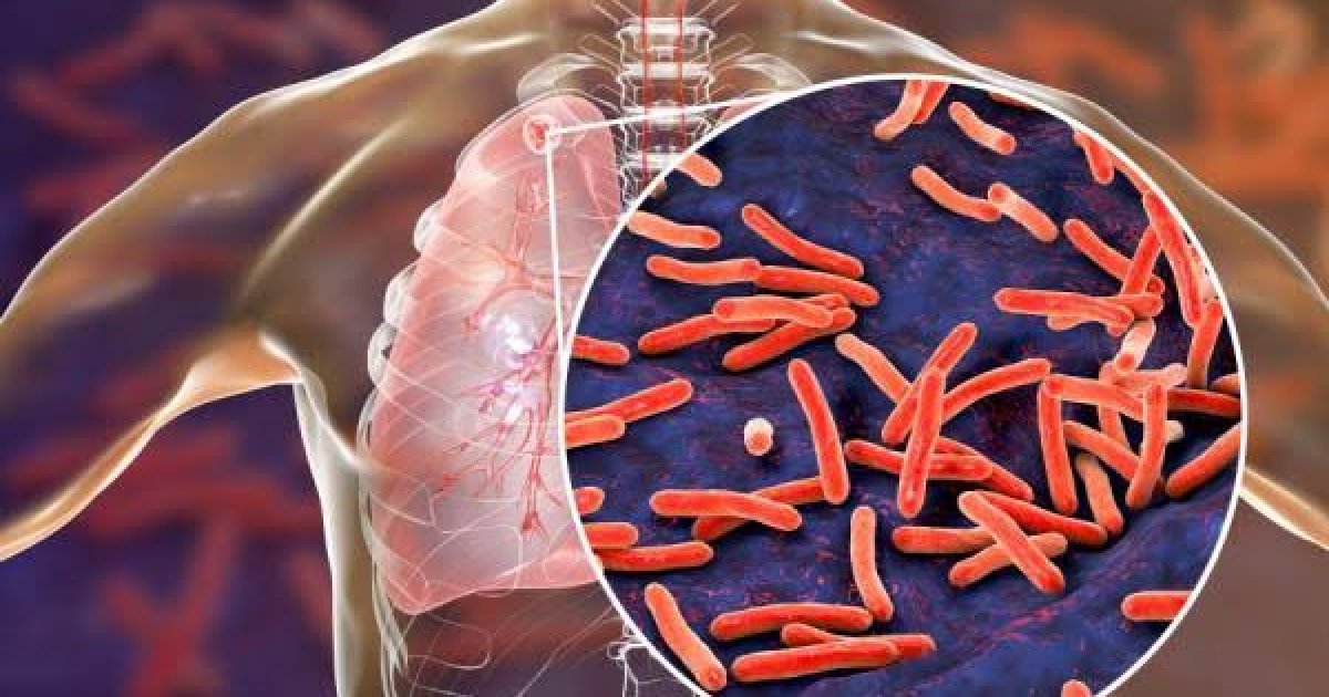  توبرکلوز؛ نښې او لاملونه یې څه دي!؟