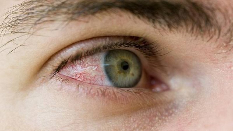 هغه ناروغۍ چې علایم یې په سترګو کې پیدا کېږي