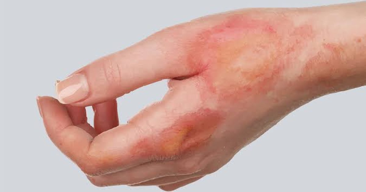 له سوځيدلي کس سره لومړنۍ مرستې