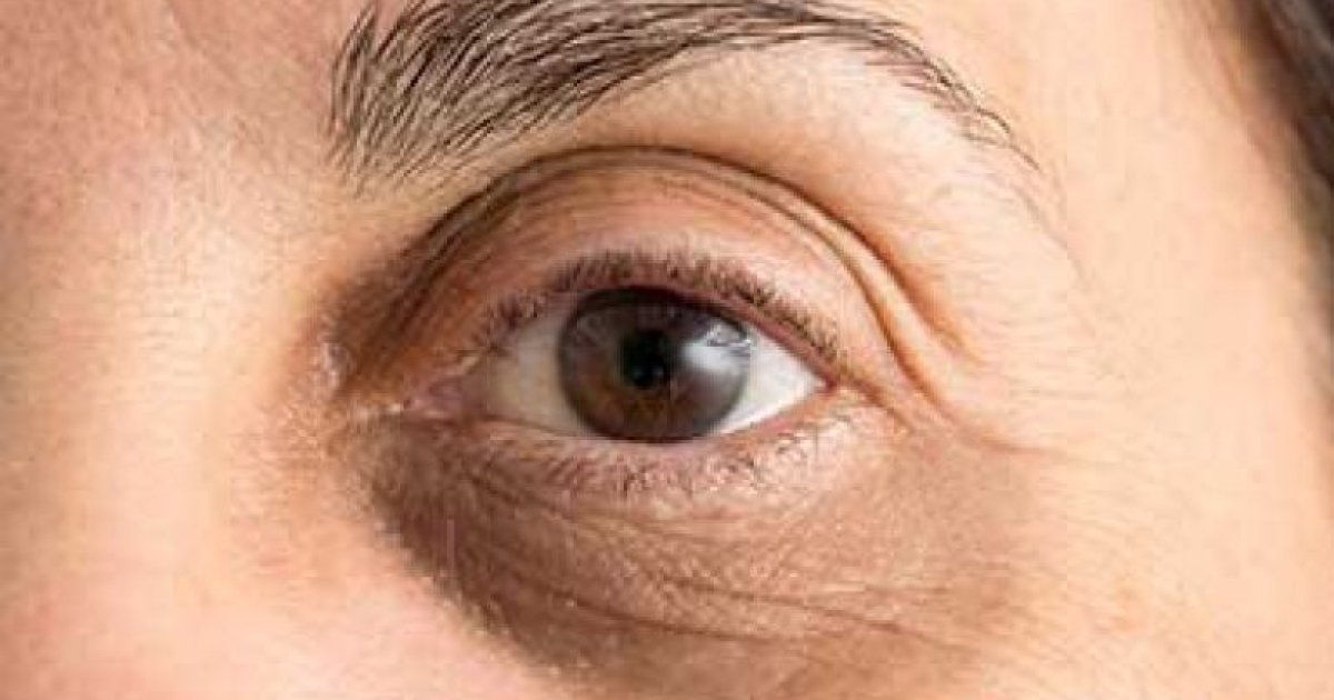 د سترګو شاوخوا تورې حلقې؛ لاملونه، مخنیوی او درملنه!