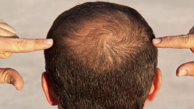 د ویښتانو تویېدنې ځينې لامولونه!